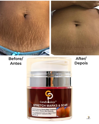 Stretch Marks & Scar Cream