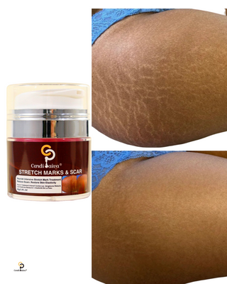 Stretch Marks & Scar Cream