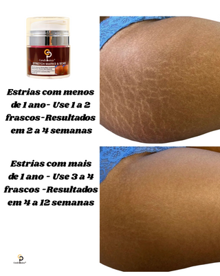 Stretch Marks & Scar Cream