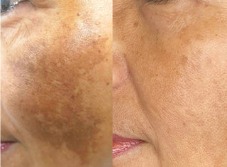Kill Melasma Hyperpigmentation Face Serum